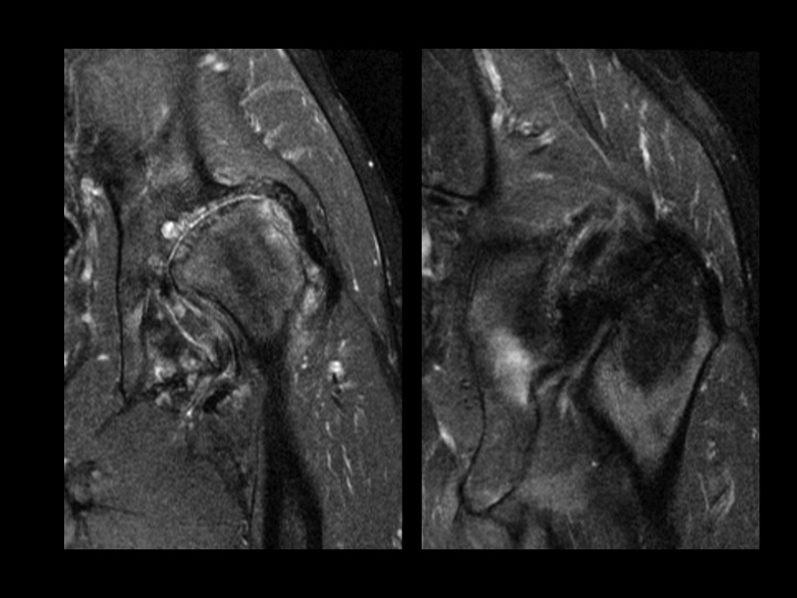 Figure 2 for case acetabular-femoral impingement